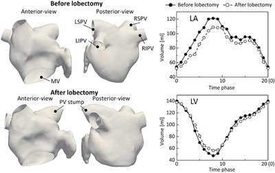 On the Impact of Left Upper Lobectomy on the Left Atrial Hemodynamics